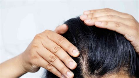 beta blockers hair loss|Beta Blockers and Hair Loss: Understanding the Connection.